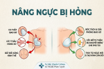 nang nguc bi hong giai phap